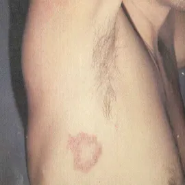 kiła trzeciorzędowa zdjęcie