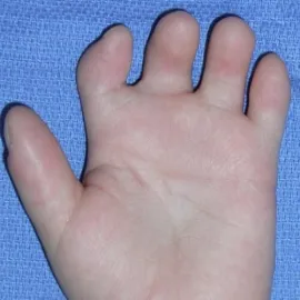 krótkie palce brachydaktylia