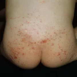 krosty na pośladkach u dziecka świerzb