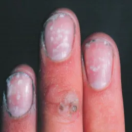 leukonychia paznokci
