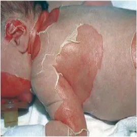 liszajec pęcherzowy noworodków