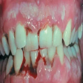 martwicze zapalenie dziąseł 