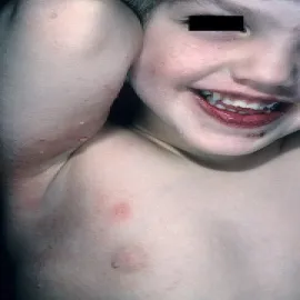 mięczak zakaźny zdjęcia