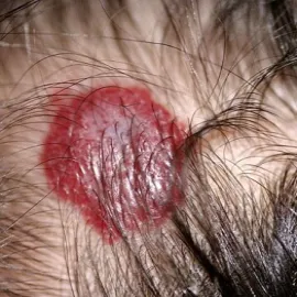 naczyniak na głowie