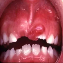 nadziąślak u dzieci 