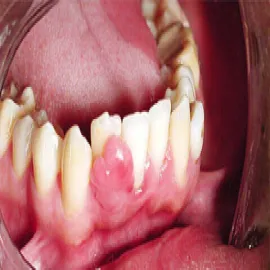 narośl na dziąśle przy zębie nadziąślak 