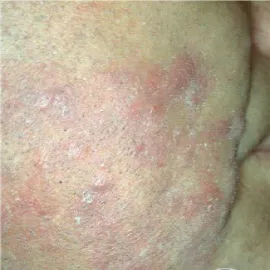 nużeniec ludzki na skórze