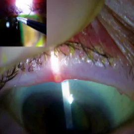 nużyca na powiekach