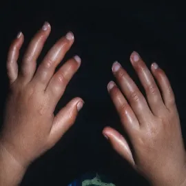 obrzęki na dłoniach erytromelalgia