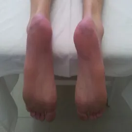 opuchnięte piekące pięty bolesny rumień kończyn 