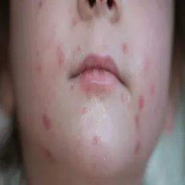 ospa u dziecka krostki na twarzy