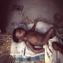 ospa wietrzna u dziecka