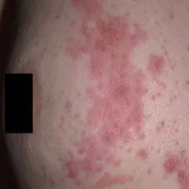 półpasiec na piersiach