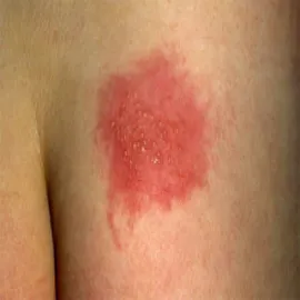 półpasiec na pośladku