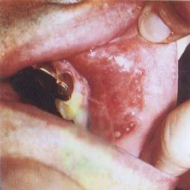 półpasiec w jamie ustnej