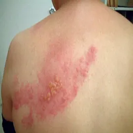 półpasiec zdjęcia