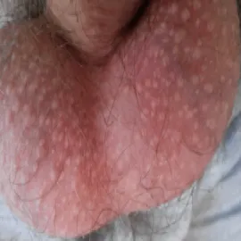 plamki fordyce'a na mosznie