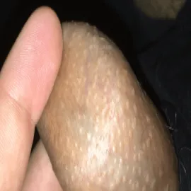 plamki fordyce'a penis