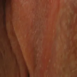 plamki fordyce'a wargi sromowe