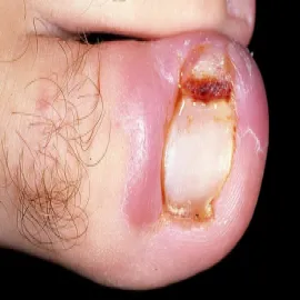 ropiejąca rana przy paznokciu