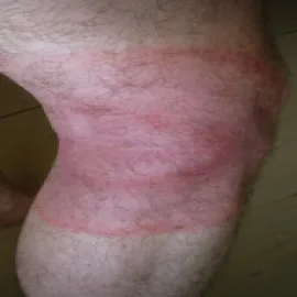 rumień na nodze zdjęcia