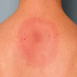 rumieniec po kleszczu na plecach