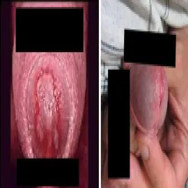 rzęsistkowica u mężczyzn