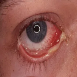 rzeżączka objawy skórne