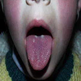 szkarlatyna język zdjęcia