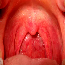 szkarlatyna w gardle u dziecka