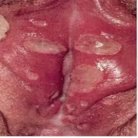 wargi sromowe choroby zdjęcia wrzód weneryczny