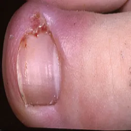 wrastający paznokieć stan zapalny