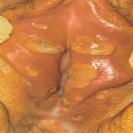 wrzód weneryczny szankier warg sromowych