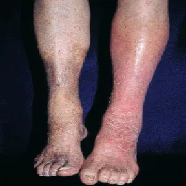 wyprysk podudzi obrzęk