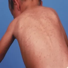 wysypka na plecach choroba odra