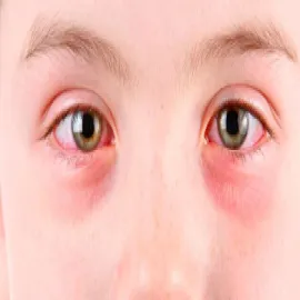 zapalenie brzegów powiek u dzieci