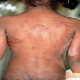 zapalenie pęcherzowe i złuszczające skóry 