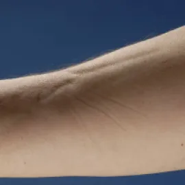 zapaleniem powięzi z eozynofilią