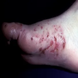 zespół Danbolta-Clossa 