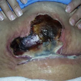 zmiany skórne choroba gangrena wilgotna