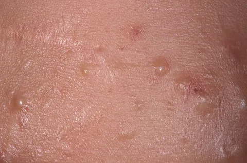 Łagodne zmiany skórne zaskórniki zamknięte