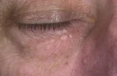 Łagodny gruczolak potowy (syringoma) 