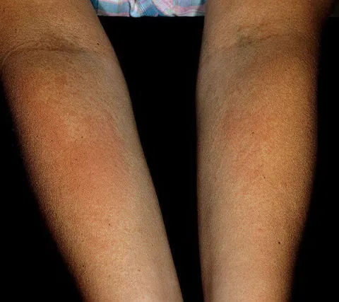 Alergia słoneczna na rękach