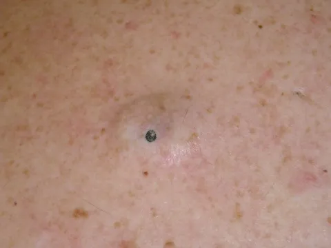 Bardzo głębokie zaskórniki