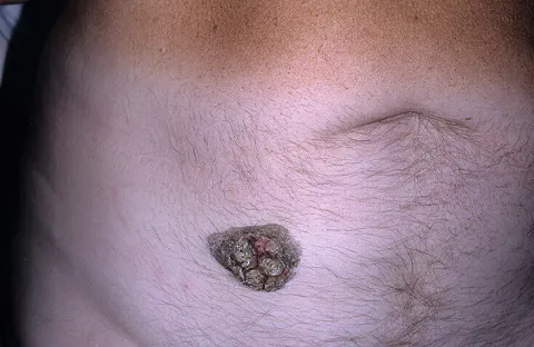 Brodawka łojotokowa na brzuchu