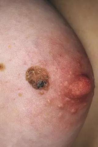 Brodawka łojotokowa na piersi