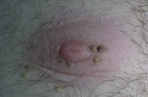 Brodawki łojotokowe na piersiach u mężczyzn