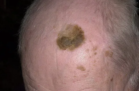 Brodawki łojotokowe na skórze głowy