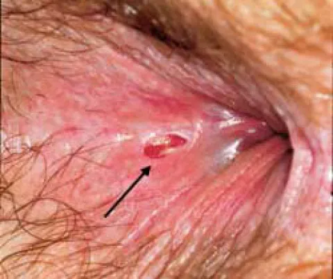 Choroby odbytu u mężczyzn szczelina odbytu 