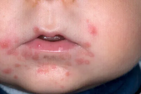 Czerwone krostki wokół ust u dziecka